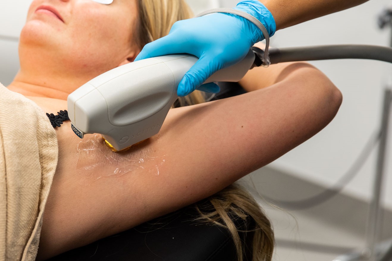 Close up of a female patient getting armpit laser hair removal near Mattoon