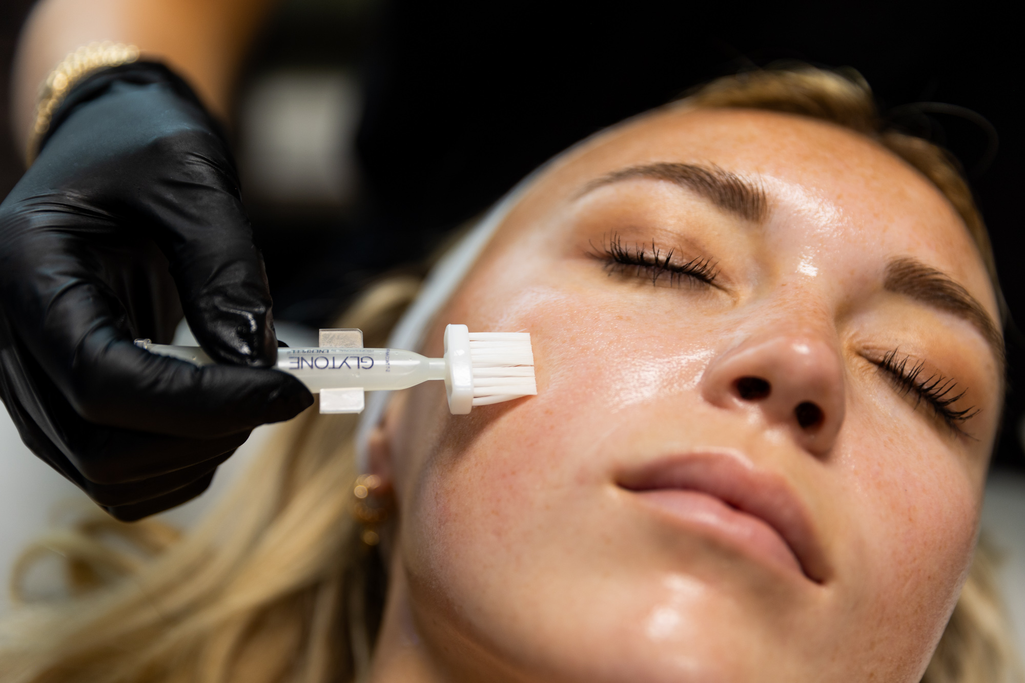 A woman gets a chemical peel for skin rejuvenation near Effingham