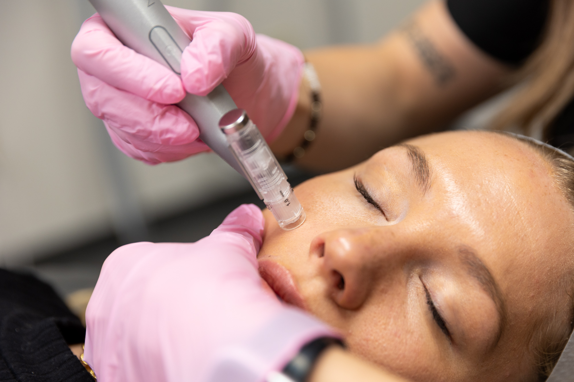 A woman receives microGLOW stamping skin rejuvenation near Effingham